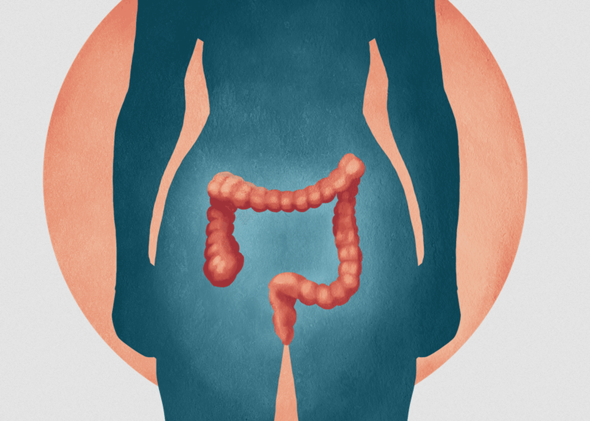 Krabbamein ristil og endaþarms