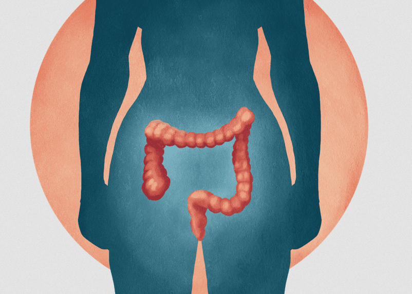 Krabbamein ristil og endaþarms